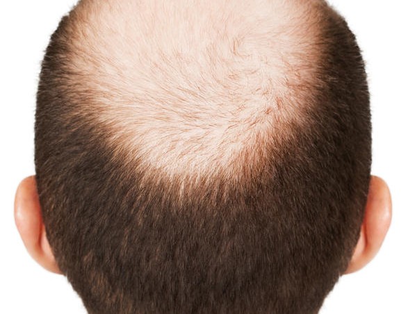 alopecia