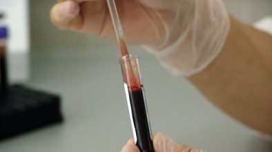 hemoglobina glicosilada